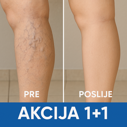 Flasteri za Vene AKCIJA 1+1 GRATIS